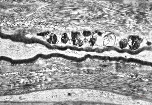 F,25y. | metachromatic leukodystrophy - n. suralis F,25y. | metachromatic leukodystrophy - n. suralis